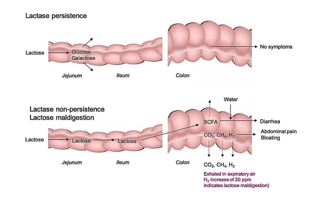 intolerancia a la lactosa, mecanismo la imagen muestra el mecanismo de la intolerancia a la lactosa en el intestino